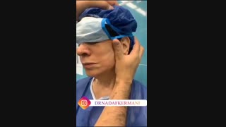 لیفت صورت و غبغب