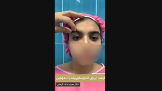 لیفت ابرو اندوسکوپیک