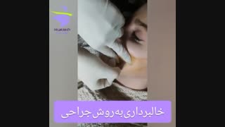 خالبرداری به روش جراحی