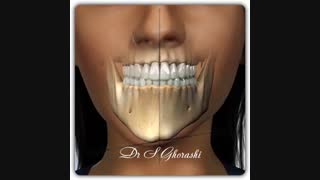 جراحی چانه | دکتر سعید قریشی