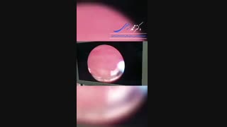 فیلم عمل جراحی TUR پروستات