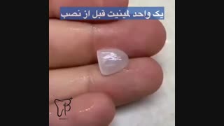 یک واحد لمینت دندان قبل از نصب