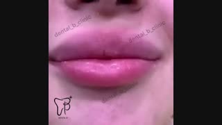 فیلم لمینت دندان