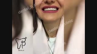 کامپوزیت دندان