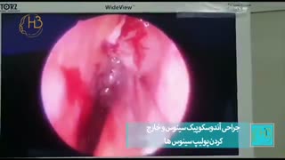فیلم عمل جراحی خارج کردن پولیپ بینی