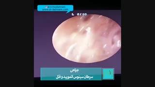 فیلم جراحی سرطان سینوس فکی و درمان بیمار بعد از 14 سال