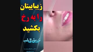 تزریق ژل لب