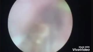 فیلم شکستن سنگ کلیه بدون  عمل جراحی