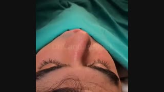 جراحی بینی طبیعی