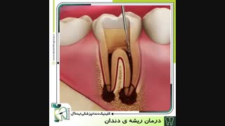 درمان ریشه دندان ( روت کانال تراپی ) | کلینیک ایده آل
