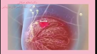 توده در بافت سینه