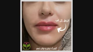 تزریق ژل لب در کلینیک توس