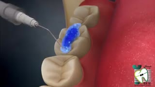 فیشورسیلانت یا شیارپوش دندان چیست؟ | کلینیک دندانپزشکی ایده آل