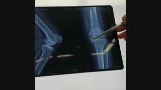 توضیح درباره تعویض مفصل زانو