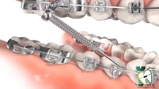 دستگاه فورسوس جایگزینی برای دستگاه هدگیر | کلینیک ایده آل