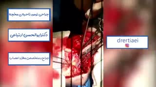 جراحی تومور ناحیه مغچه