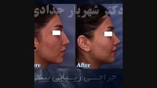 جراحی بینی