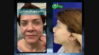 جراحی لیفت صورت و گردن