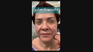 جراحی لیفت صورت