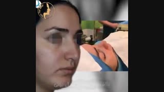 بلافاصله بعد از جراحی بینی