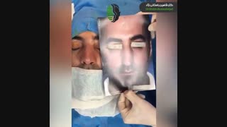 عمل بینی گوشتی و بزرگ