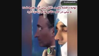 جراحی بینی بلند