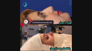بلافاصله بعد از عمل بینی | دکتر گلی