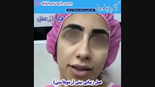 عمل زیبایی بینی