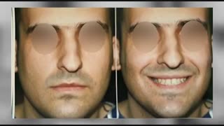 عمل بینی استخوانی با انحراف | دکتر ابراهیمی لیزر مو