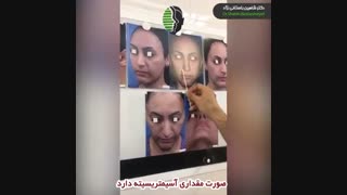 فیلم جراحی بینی ترمیمی