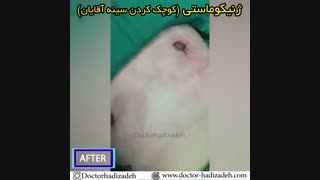 جراحی کوچک کردن سینه آقایان