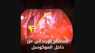 علاج مریض مصاب بالطلقه تحت الحنک و الجبین