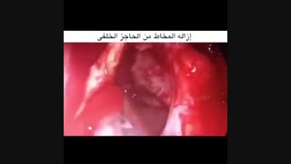 صداع فی ناحیه خلف العین
