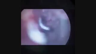التهاب جیوب الفطریه