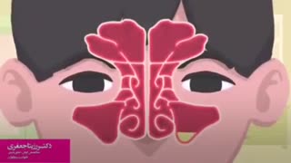 التهاب جیوب الانفیه