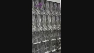 درمان تنگی شدید کانال کمری و جابجایی مهره های ستون فقرات