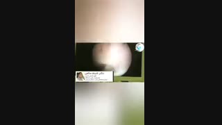 سندرم آشرمن چسبندگی شدید داخل رحمی