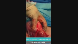 عمل لاپاراتومی میومکتومی فیبروم 10 سانت