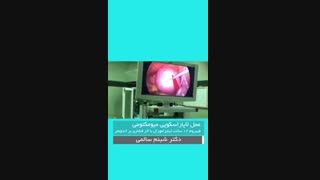 عمل لاپاراسکوپی میومکتومی فیبروم
