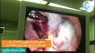 عمل لاپاراسکوپی پیچ خوردگی تخمدان