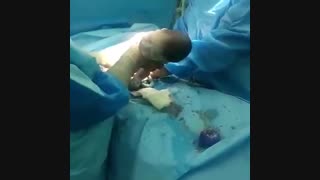 فیلم عمل زایمان سزارین با یک همراه