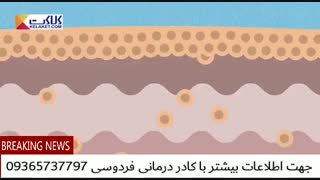بیماری پوتی پسوریازیس را بهتر بشناسیم..