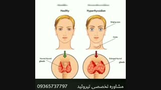 درمان قطعی تیروئید کم کار و پر کار..
