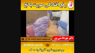 رفع افتادگی صورت با نخ