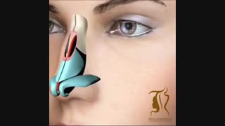 برداشتن قوز بینی