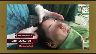 لیفت ابرو