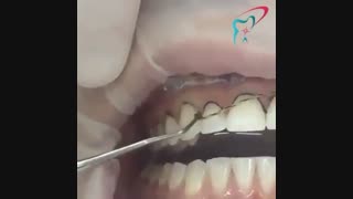 قرار دادن نخ زیر لثه برای قالب گیری