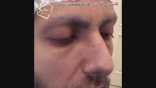 کاشت مو به روشSUT -کلینیک تخصصی رنسانس لیفت پیشانی