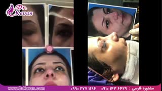 عمل همزمان بینی و پلک بالایی توسط دکتر کاوان