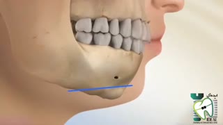 جراحی فک | کلینیک دندانپزشکی ایده آل